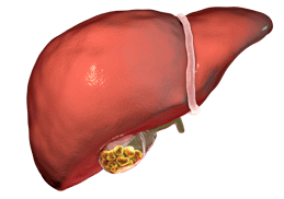 Gallstone Gallbladder stones Cholecystectomy