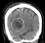 Tomografia após a cirurgia com remoção total do tumor.