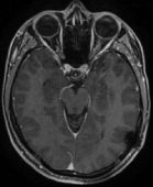 Ressonância após a cirurgia no cérebro com a remoção total do tumor e sem crises.