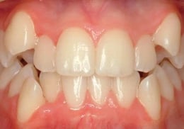 affordable tooth removal