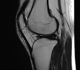 Knee MRI