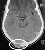 Tomografia de menino de 12 anos com abaulamento occipital há 2 semanas. Tumor ósseo.