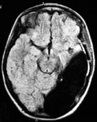 Ressonância após a cirurgia no cérebro e remoção total dos túberes. Ela se curou da epilepsia.