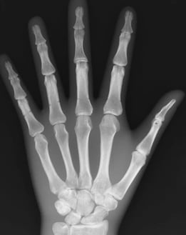 Hand Xray