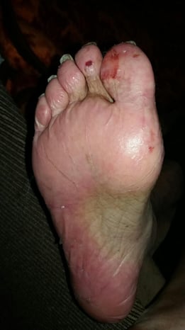 Plantar Erythrodysesthesia
