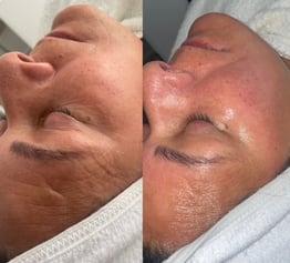 Microdermabrasion