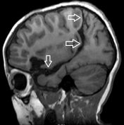 Ressonância após a cirurgia no cérebro e desconexão da displasia cortical.