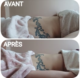 avant/après drainage renata franca grenoble
