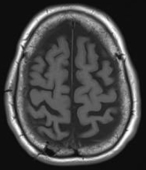 Ressonância após a cirurgia no cérebro e remoção do hematoma subdural crônico. com boa recuperação.