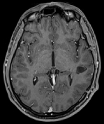 Ressonância após a cirurgia com remoção total do cavernoma e paciente livre de epilepsia.
