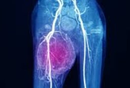 وهل لها من علاج sarcoma ساركوما