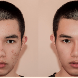 Acne treatment