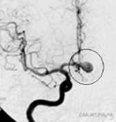 Angiografia projeção frontal mostrando o aneurisma cerebral.