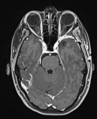 Ressonância após a cirurgia com remoção total do tumor e melhora da dor.