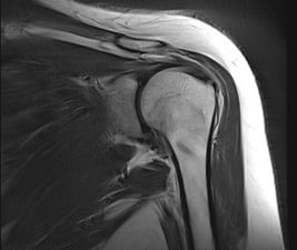 Shoulder MRI