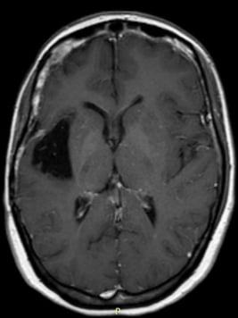 Ressonância após a cirurgia com remoção total do tumor.