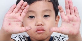 infeksi kulit pada anak