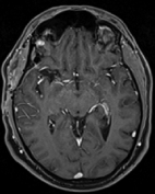 Ressonância após a cirurgia com remoção total do cavernoma e paciente livre de  epilepsia.
