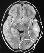 Ressonância de menina de 10 anos com epilepsia desde os 2 anos de idade com túberes (cíuculos).