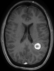Ressonância da paciente com cefaleia antes da cirurgia de cavernoma no cérebro.