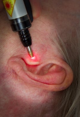 Electro-laser acupuncture on an ear