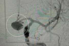 Angiografia projeção frontal mostrando o volumoso aneurisma cerebral.
