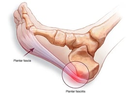Solución Fascitis Plantar