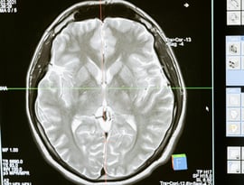 Vista de pantalla de monitor mostrando un corte sagital de cerebro
