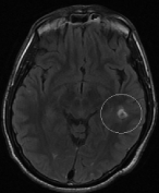 Paciente com epilepsia e cavernoma antes da cirurgia no cérebro.