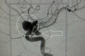 Angiografia digital projeção perfil mostrando 2 aneurismas cerebrais. 