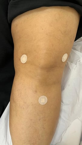 tratamento para artrose do joelho sem cirurgia