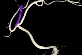 Angiografia digital 3D após a cirurgia no cérebro e clipagem do aneurisma cerebral (clipe em roxo).