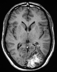 Ressonância de paciente epiléptico com grande tumor occipital esquerdo antes da cirurgia no cérebro.