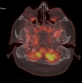 PET CT showing infective process (reddish)