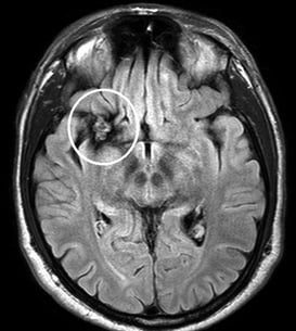 Paciente epiléptico com cavernoma antes da cirurgia no cérebro.