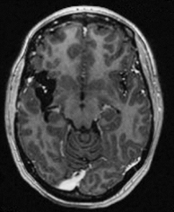 Ressonância após a cirurgia com remoção total do tumor.