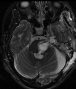 Ressonância corte axial após a cirurgia no cérebro e remoção total do cavernoma.