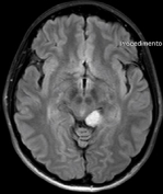Ressonância de paciente com tumor temporal medial esquerdo antes da cirurgia no cérebro.