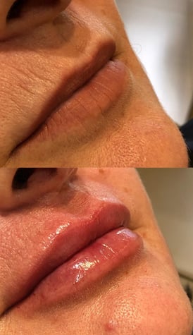 Preenchimento labial natural, sem exageros. Tecnica lipkiss