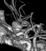 Reconstrução 3D da angiotomografia projeção perfil mostrando o aneurisma cerebral.