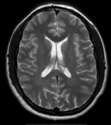 Ressonância após a cirurgia com remoção total do tumor. 