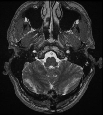 Ressonâcia magnética após a cirurgia com remoção total do tumor.
