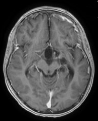 Ressonância magnética após a cirurgia com a retirada total do tumor.