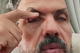 عسل غلى العين الجفن العلوى
