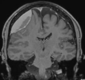 Ressonância de homem de 50 anos com volumoso hematoma subdural crônico fronto-parietal direito.
