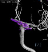 Reconstrução 3D da angiotomografia após a cirurgia no cérebro e clipagem do aneurisma cerebral.