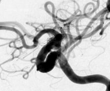 Angiografia após a cirurgia no cérebro e clipagem do aneurisma cerebral. Projeção perfil.