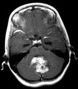 Ressonância de uma menina com cefaleia e vômitos, com volumoso tumor no cerebelo antes da cirurgia.