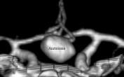 Reconstrução 3D da angiotomografia projeção frontal mostrando o volumoso aneurisma cerebral.