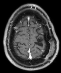 Ressonância após a cirurgia com a remoção total do tumor e paciente livre de epilepsia.
